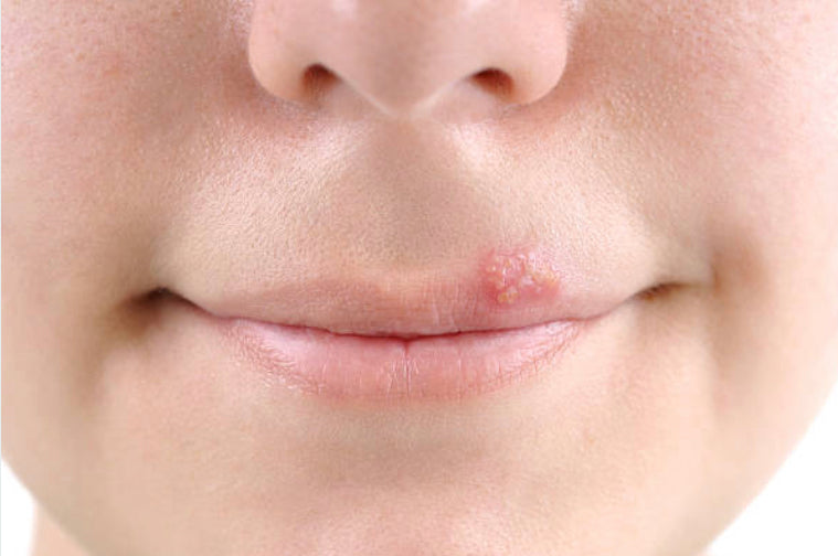 What is a good way to get rid of cold sores?